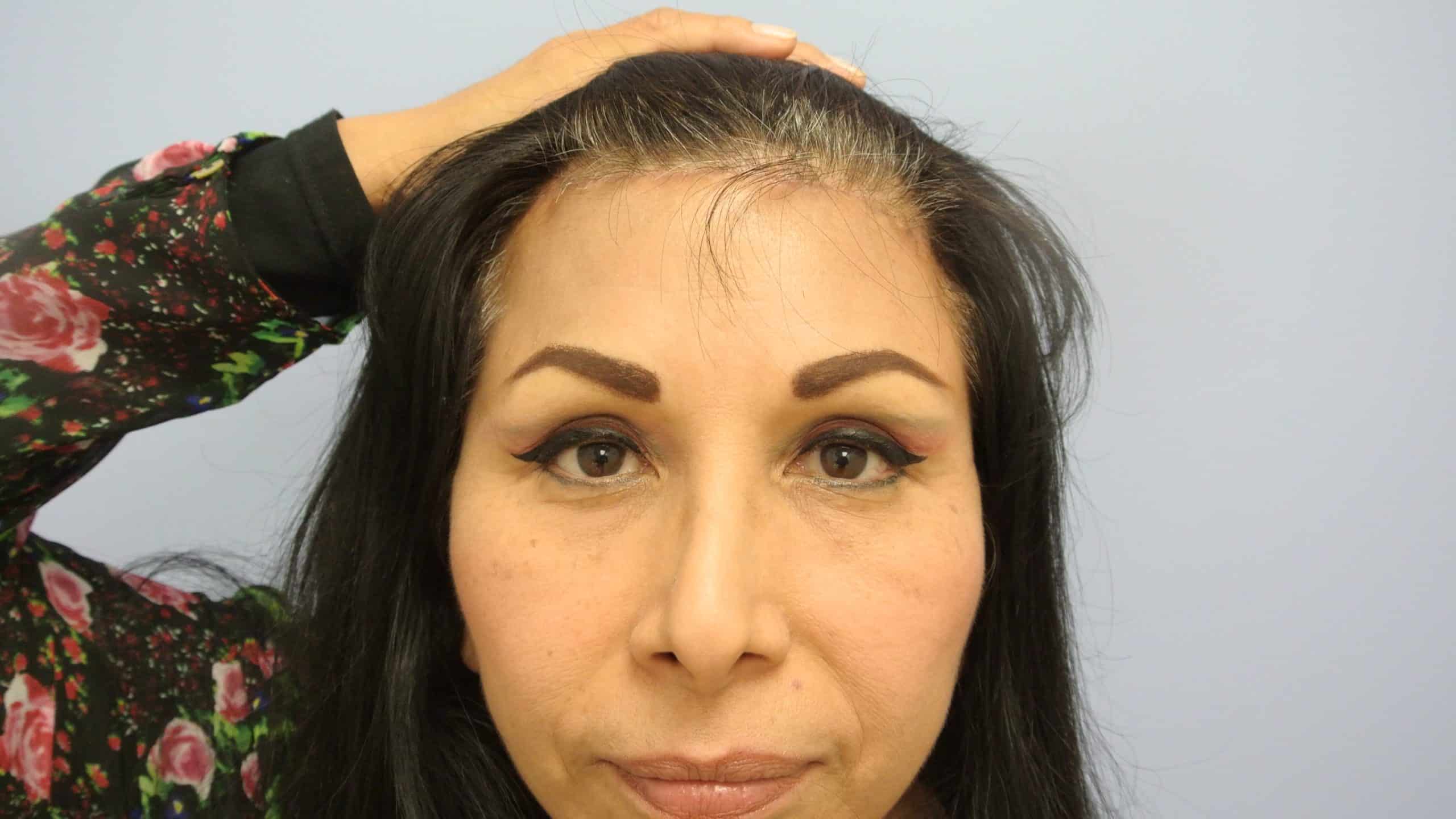 Eyebrow transplant repair at 1 year by Dr. Lindsey